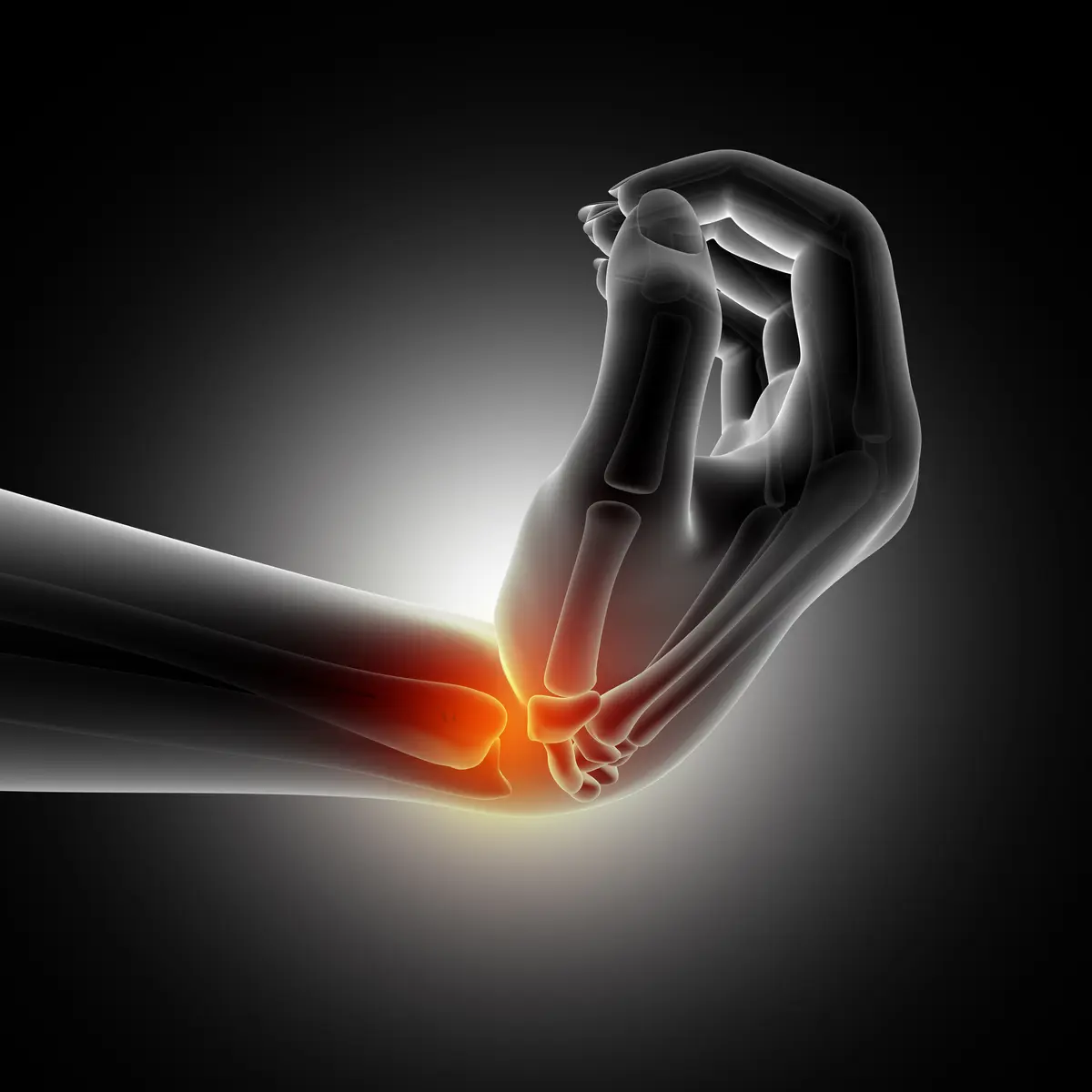 Syndrome du Canal Carpien : Diagnostic et Traitement Chirurgical