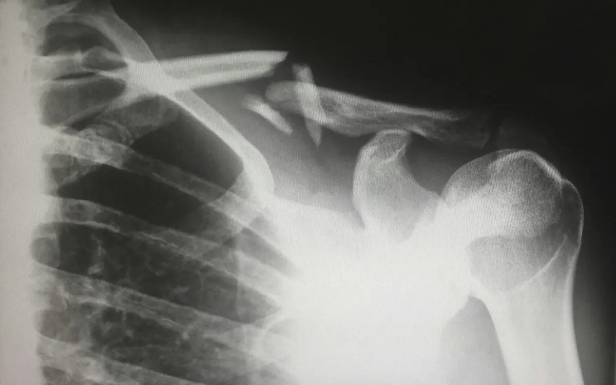 Fractures chez l'Enfant et l'Adulte : Traitement, Plâtre et Immobilisation
