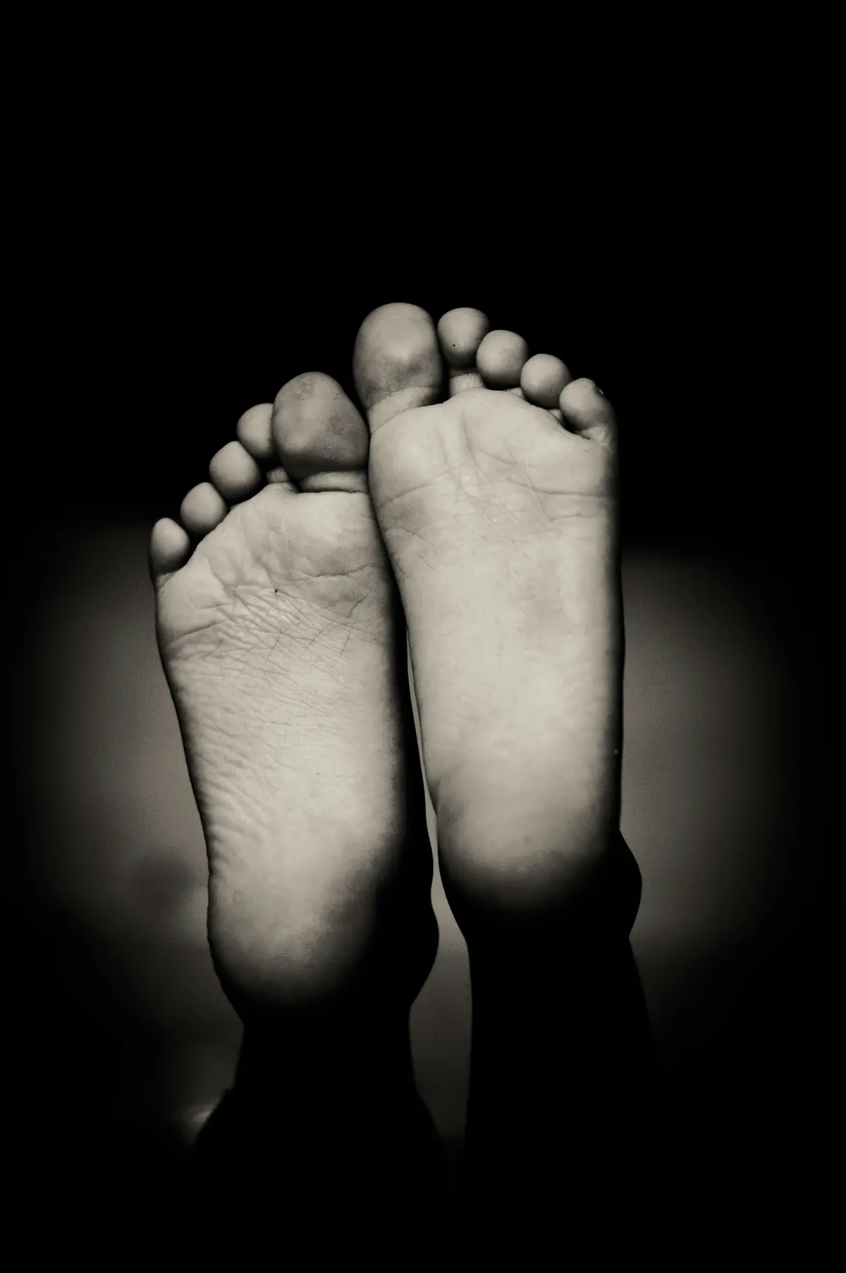 Pieds Plats et Hallux Valgus : Diagnostic et Traitement Chirurgical