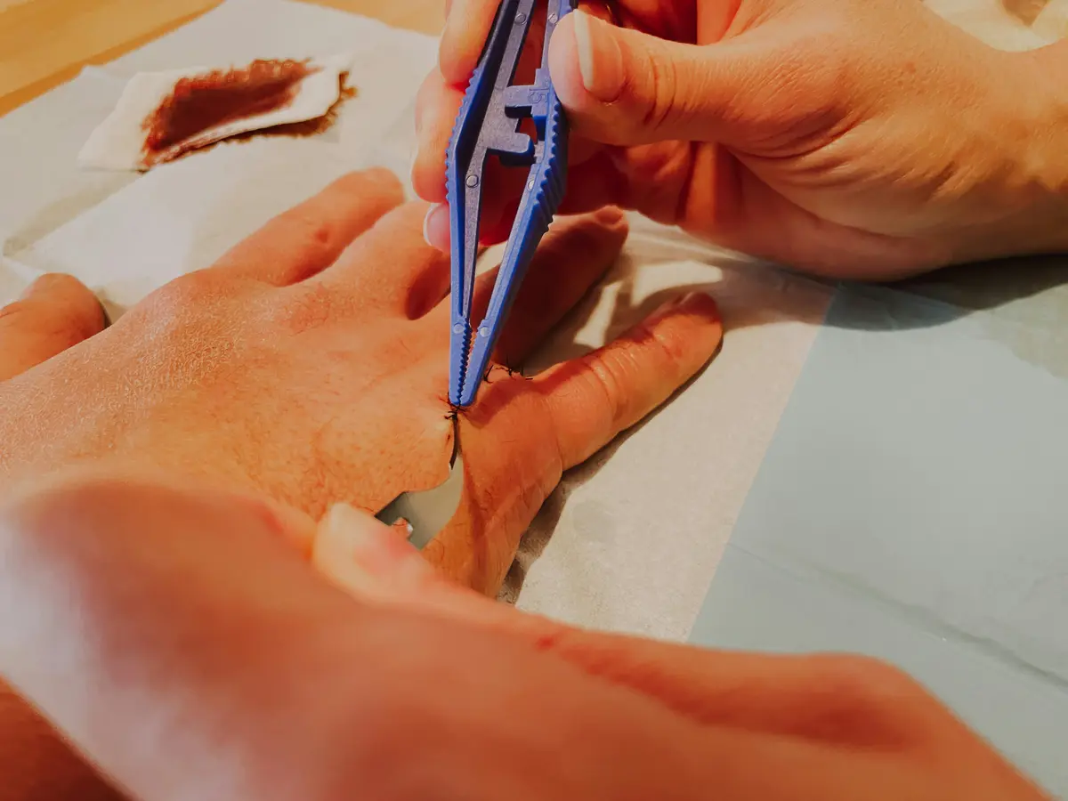 Plaies Tendineuses et Nerveuses : Urgence et Réparation Chirurgicale